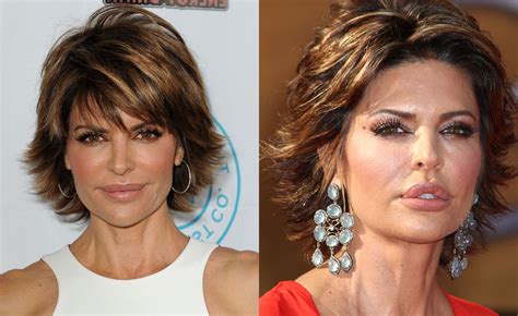 lisa rinna before surgery.